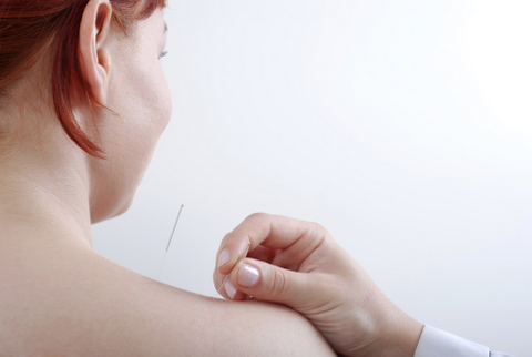 A medical doctor performs acupuncture on a patients back